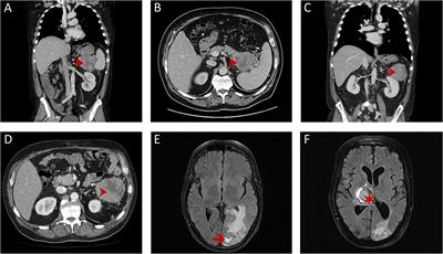 HROP68: A rare case of medullary pancreatic cancer—characterization and chemosensitivity of the first patient-derived cell line